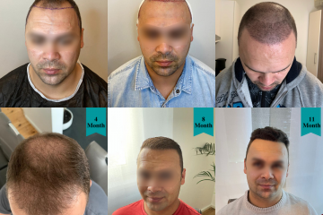 Processus de développement de la greffe de cheveux