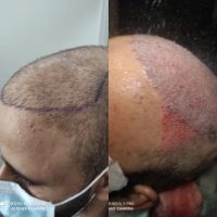 هل يمكن تصحيح زراعة الشعر الفاشلة؟