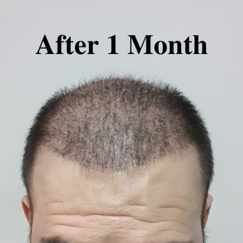 Hair Transplantation After 1 Month