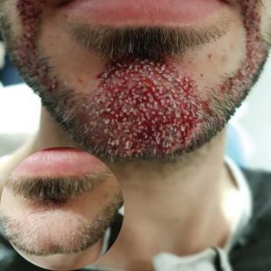 Beard Transplantation