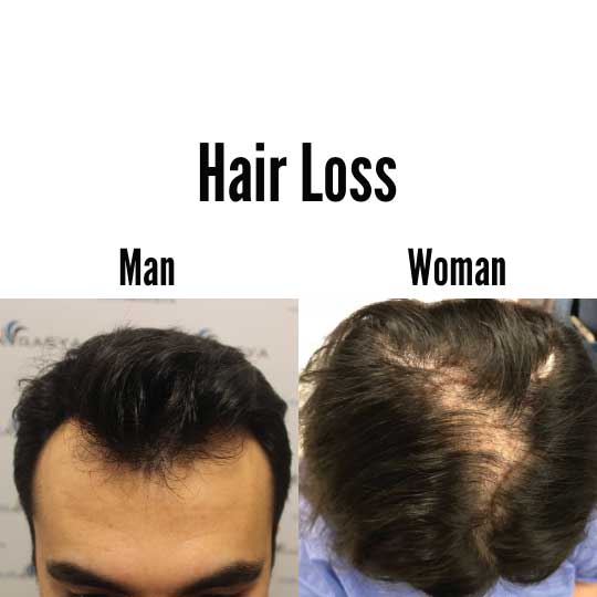 Hair Loss