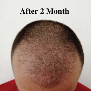 Trasplante de cabello después de 2 meses