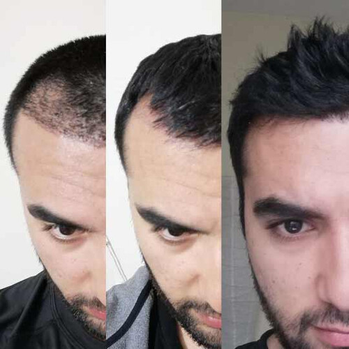 Shock Loss After Hair Transplant