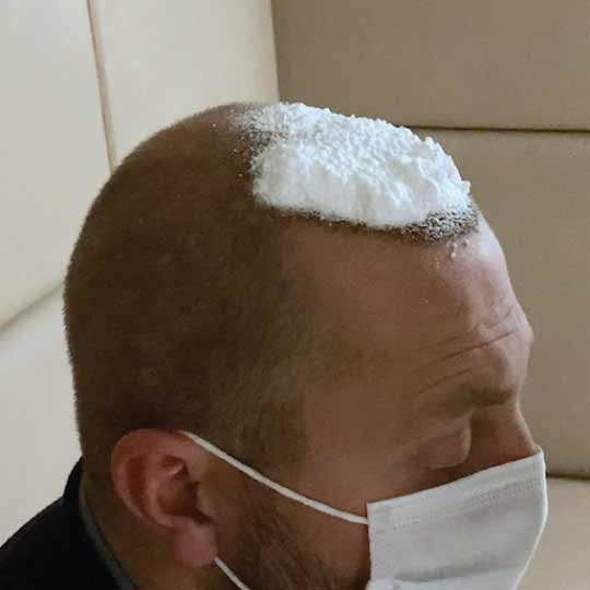 Healing Process After Hair Transplantation