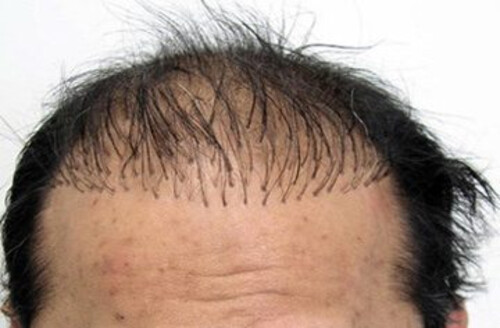 Causes of Unsuccessful Hair Transplant