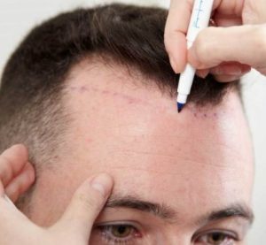 فضولي حول زراعة الشعر