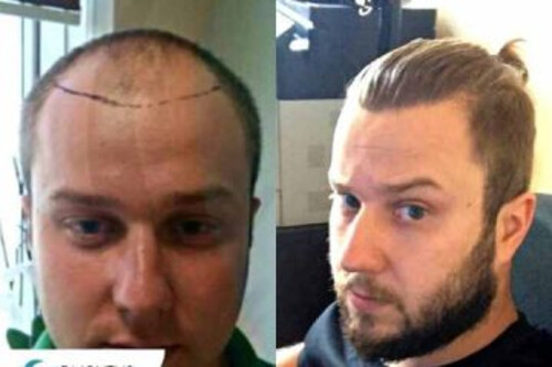 Details of Successful Hair Transplant